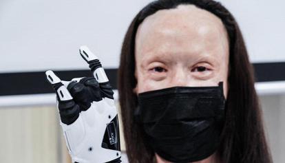 Valentina Pitzalis, sfigurata nel 2011 dal marito ha una mano bionica di nuova generazione