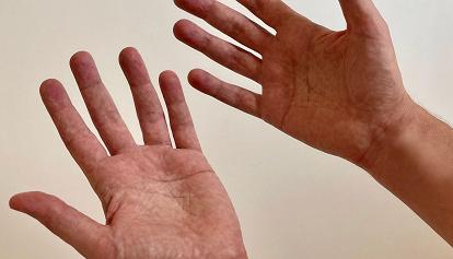 Parla della sua malattia e pubblica la foto delle mani
